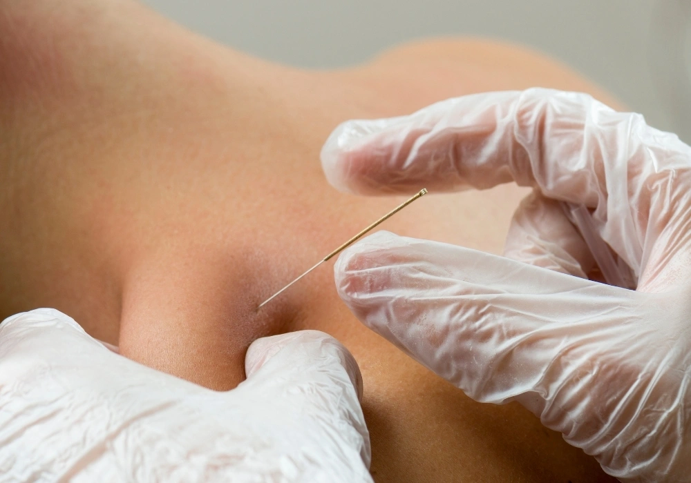 Dry Needling